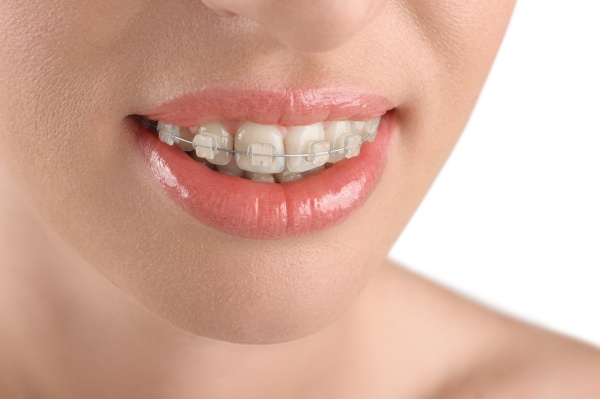 The Pros and Cons of Ceramic Braces - Belmont Smiles - Orthodontist Belmont, MA