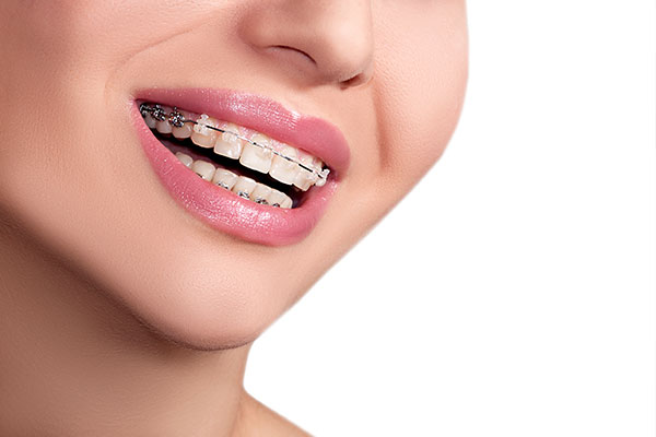 How to Care for Ceramic Braces - Belmont Smiles - Orthodontist Belmont, MA