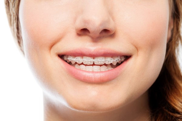 Why Clear Braces For Teens Are Recommended