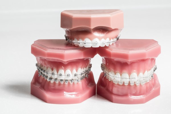 What Are Corrective Braces?